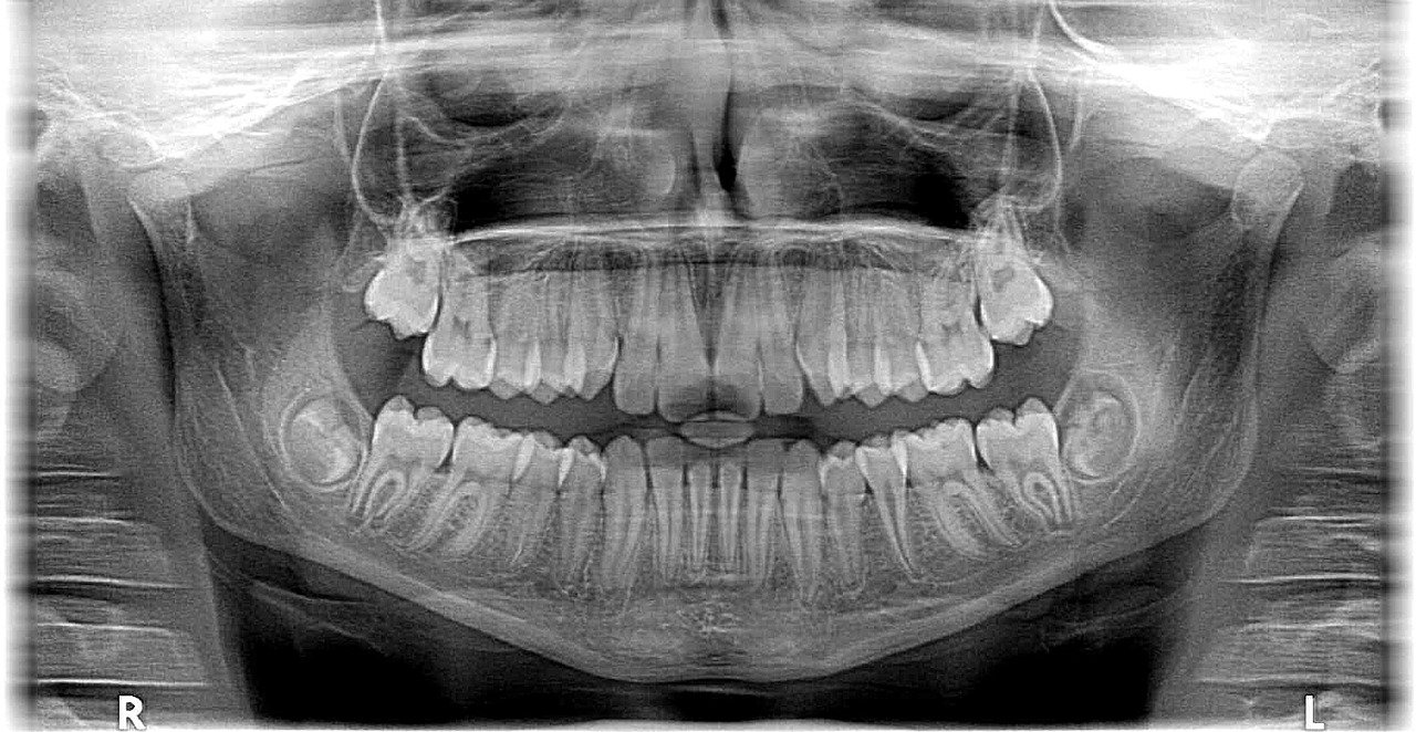 Czym jest RTG zębów?